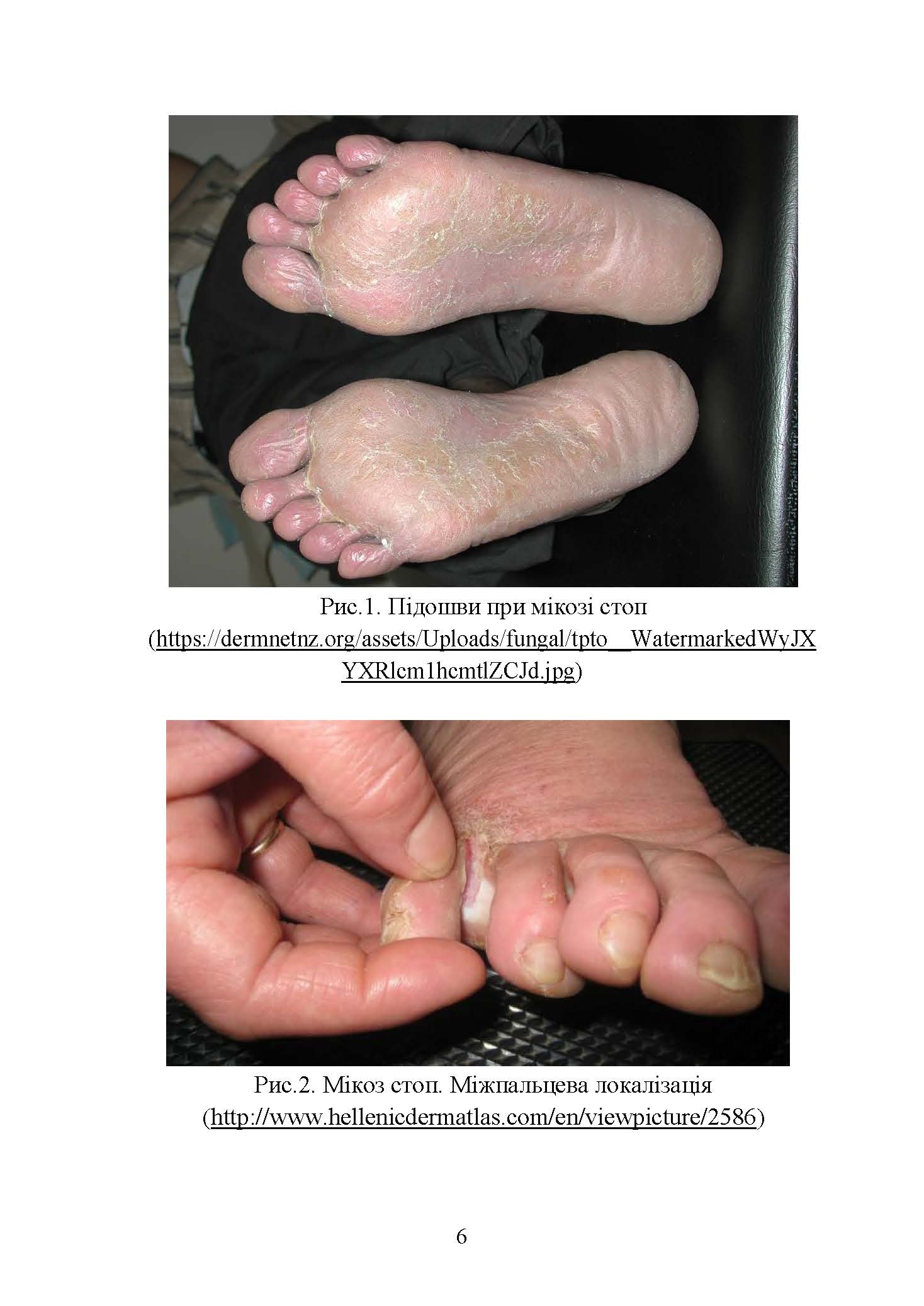 Подологічна допомога військовослужбовцям на догоспітальному етапі. . 